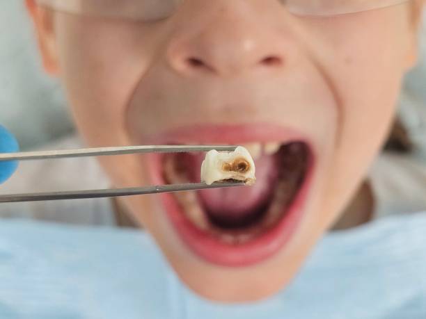 Best Emergency Wisdom Teeth Removal in Blooming Prairie, MN